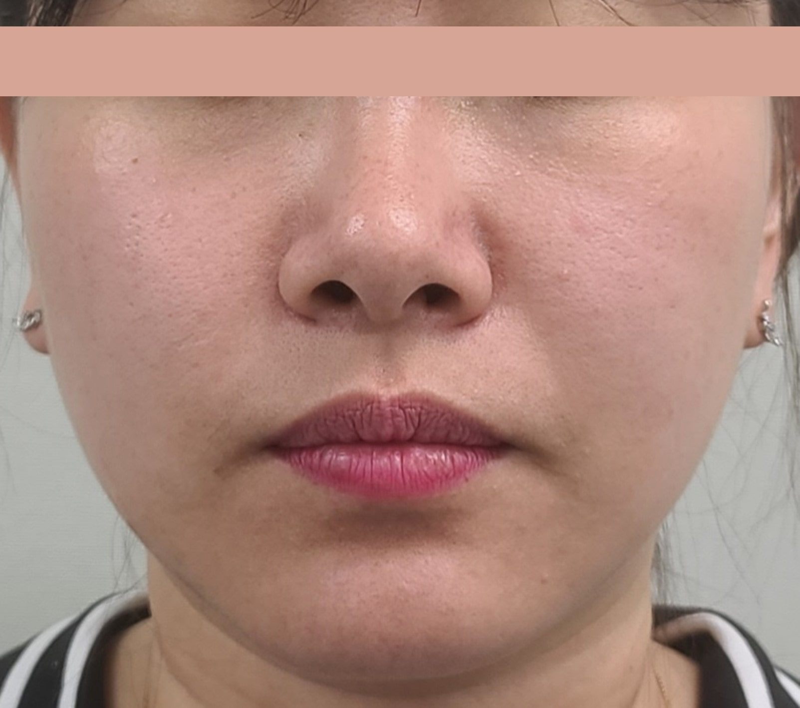 Patient after Denza treatment