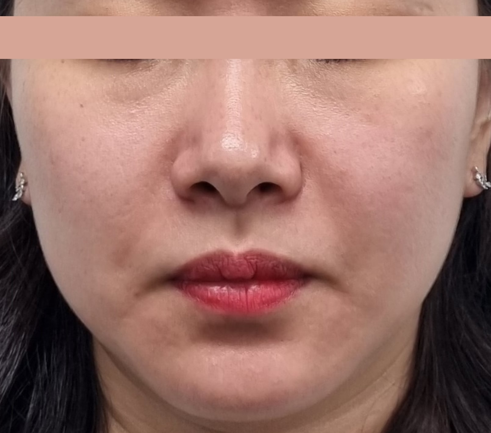 Patient before Denza treatment