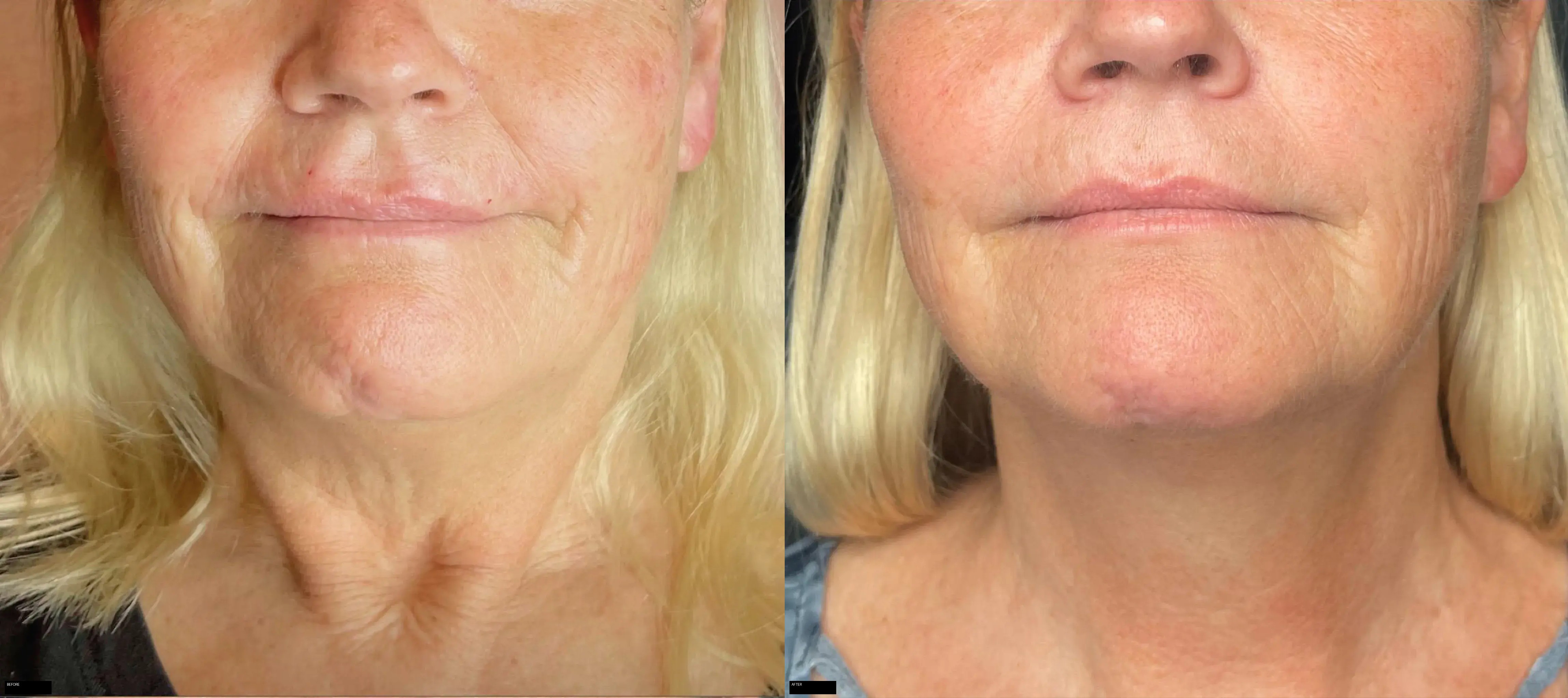 Denza before and after: front neck and chin contouring