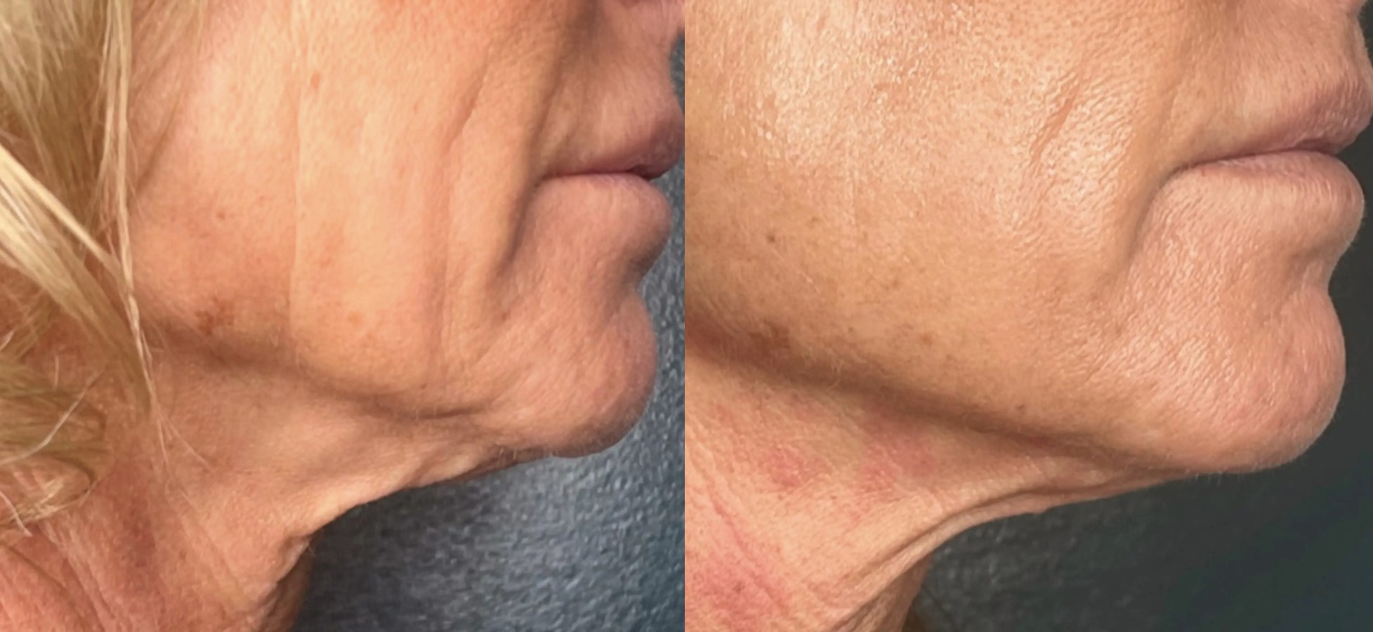 Denza before and after: neck skin tightening