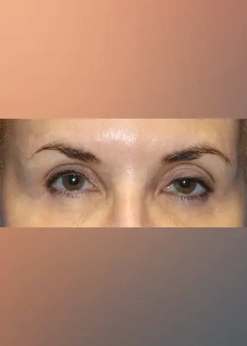 Periorbital after Denza treatment