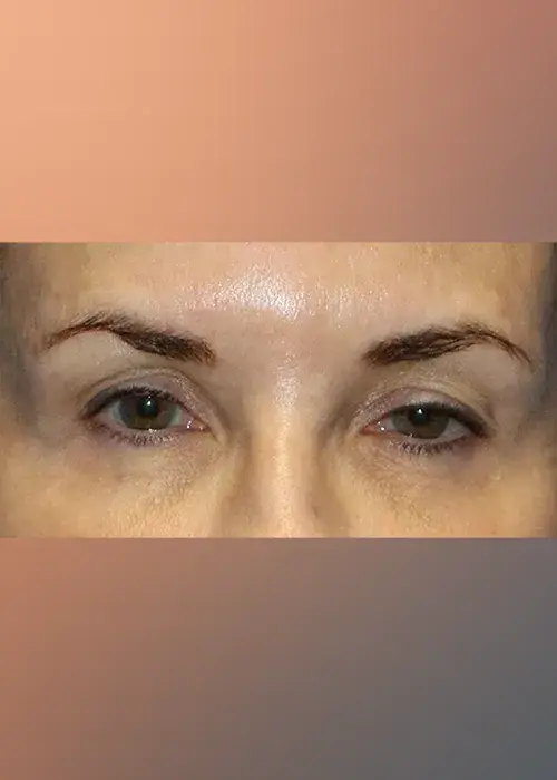 Periorbital before Denza treatment