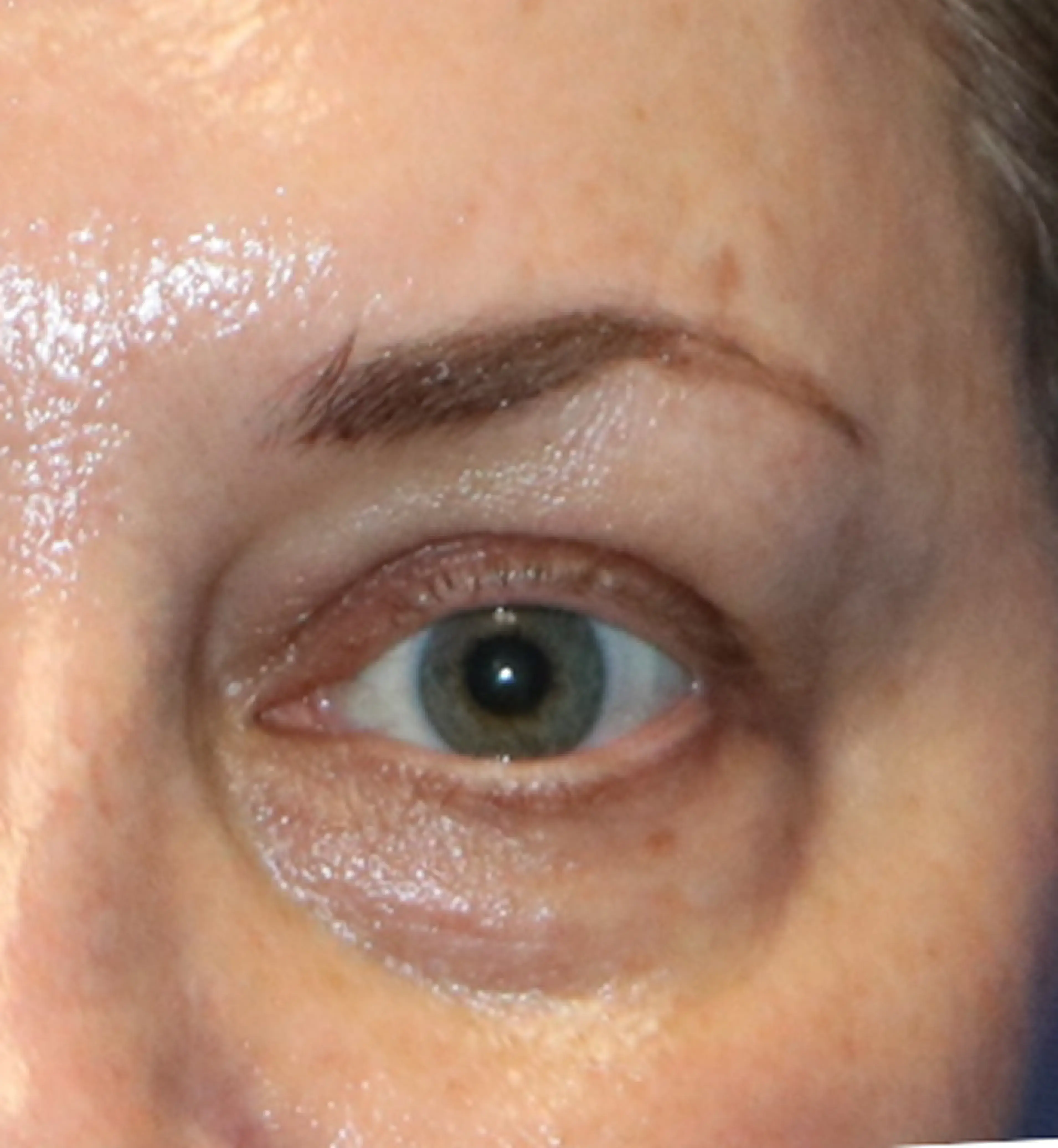 Eye Area after Denza treatment