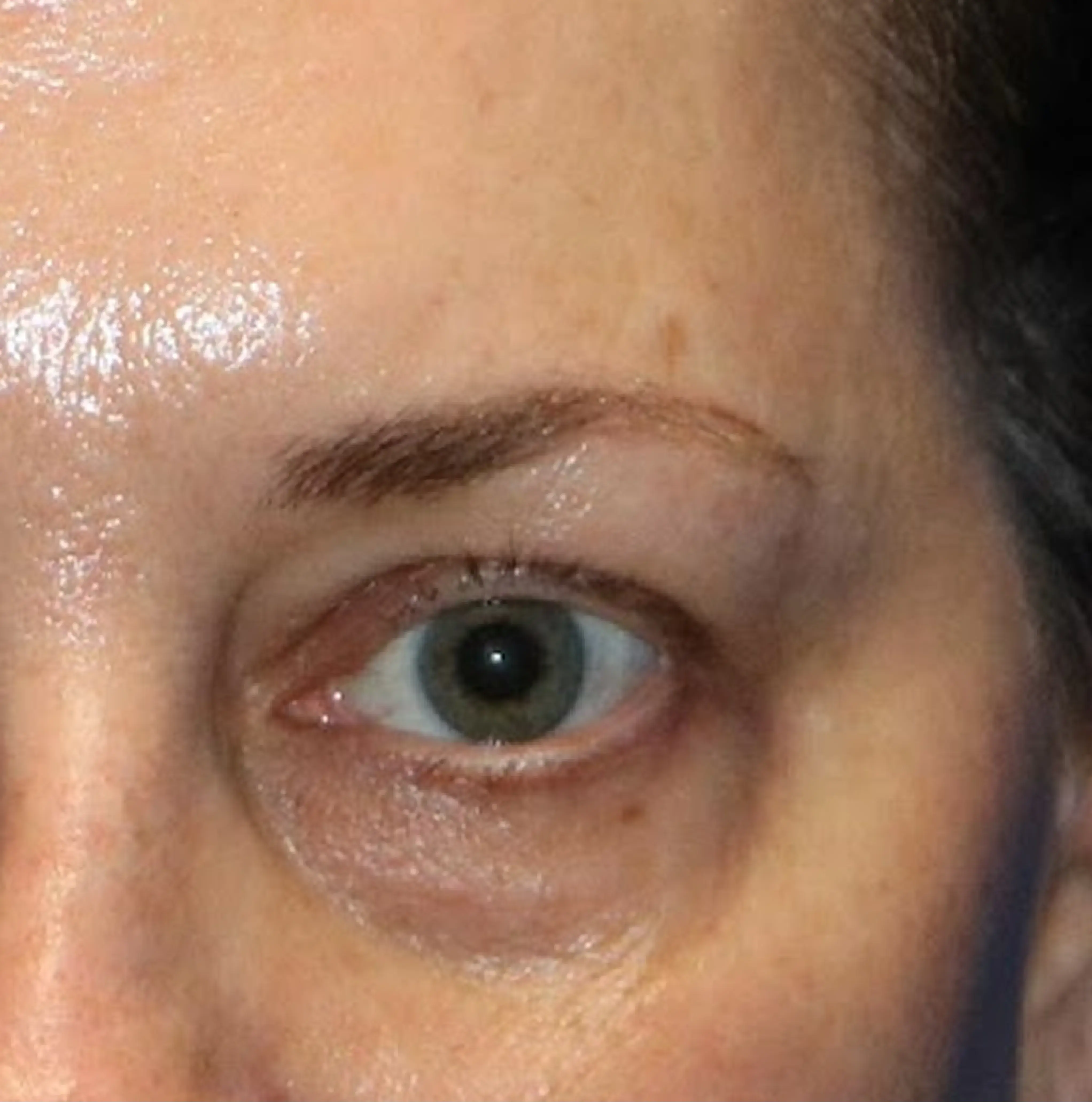 Eye Area before Denza treatment