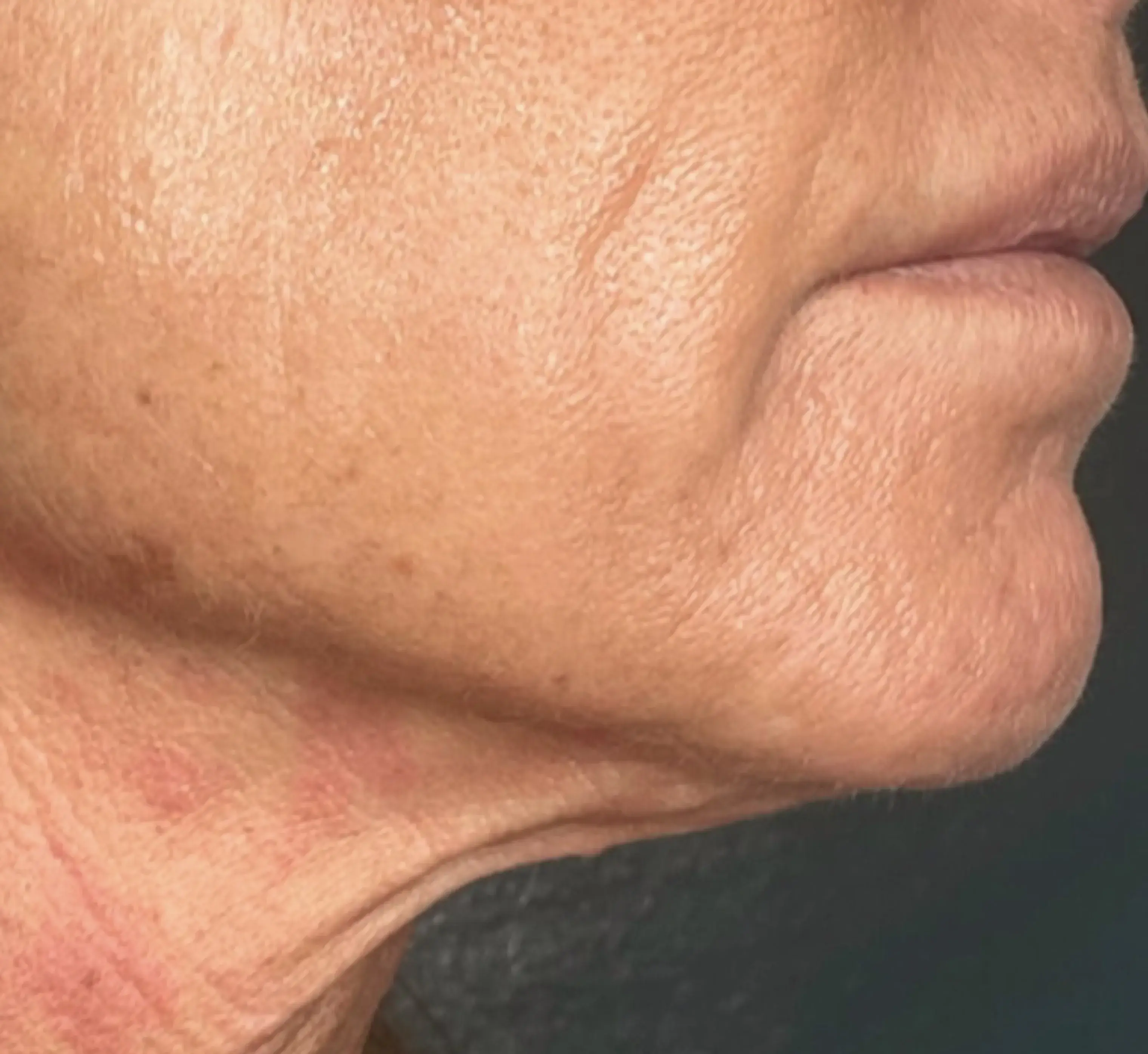 Neck & Jawline after Denza treatment