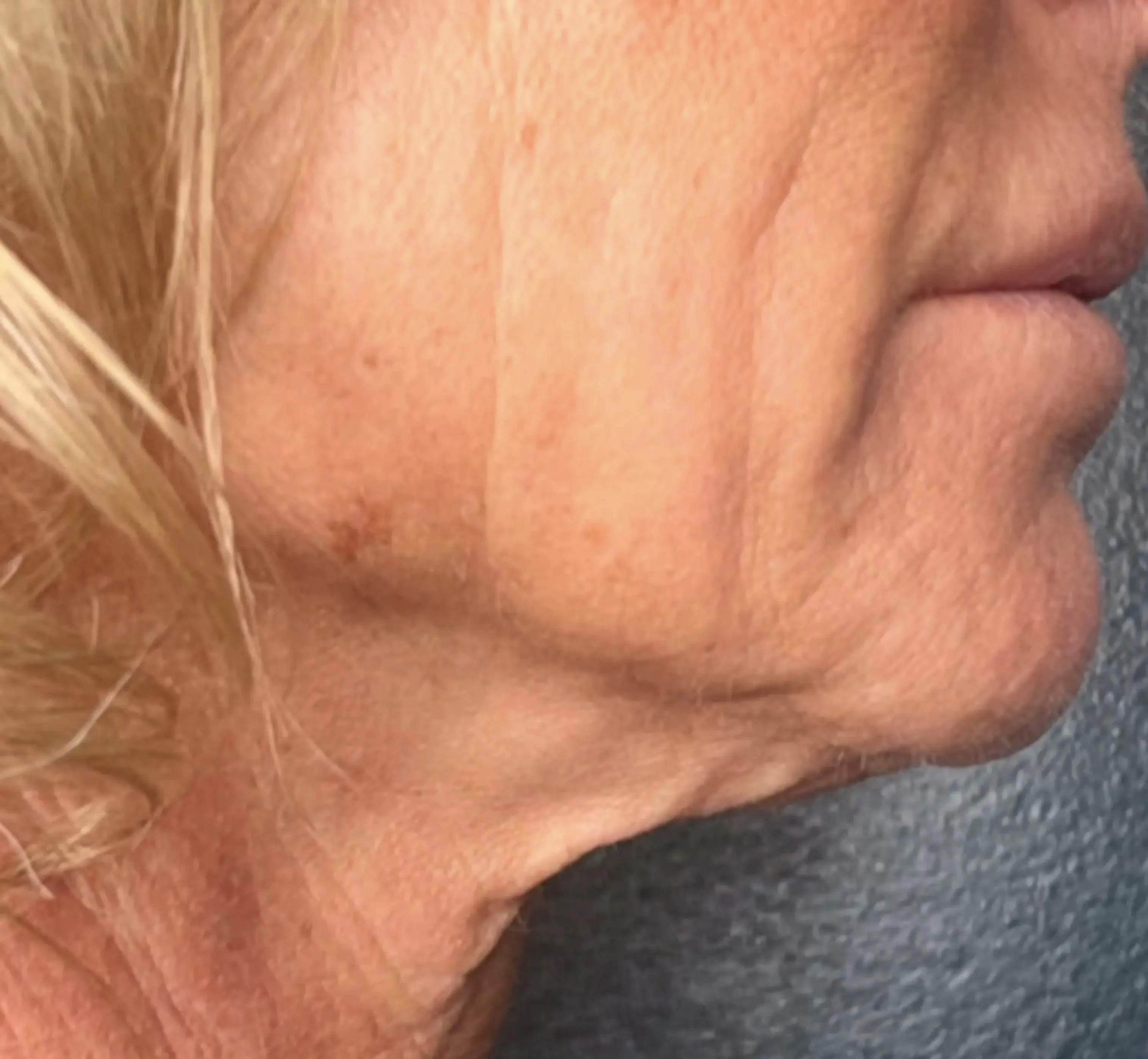 Neck & Jawline before Denza treatment