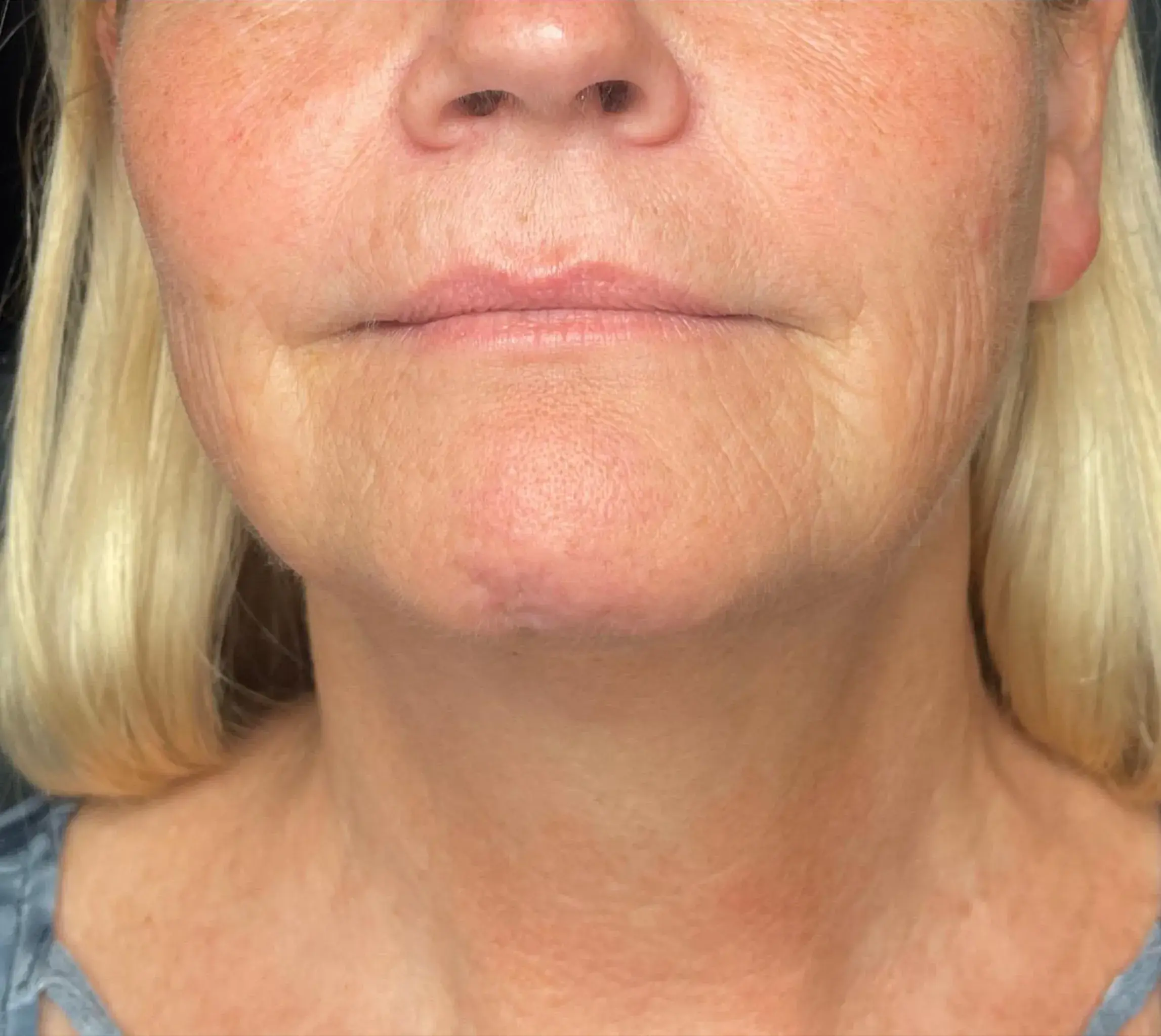 Neck Contour after Denza treatment