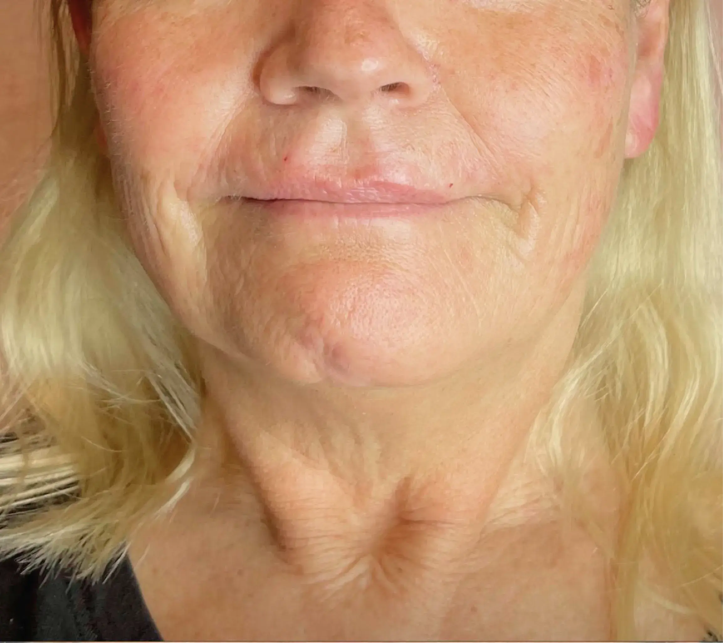 Neck Contour before Denza treatment