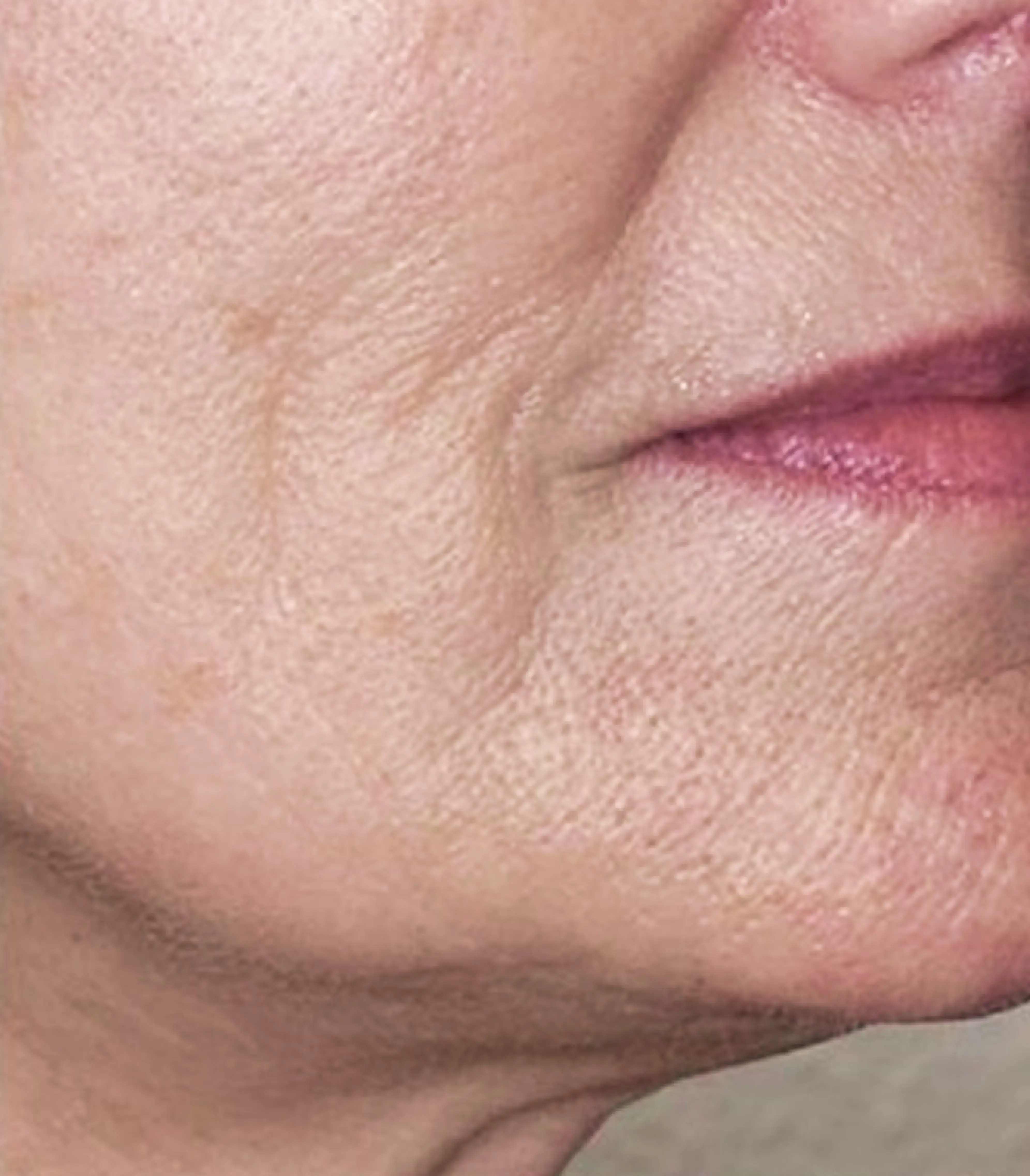 Neck Lift after Denza treatment