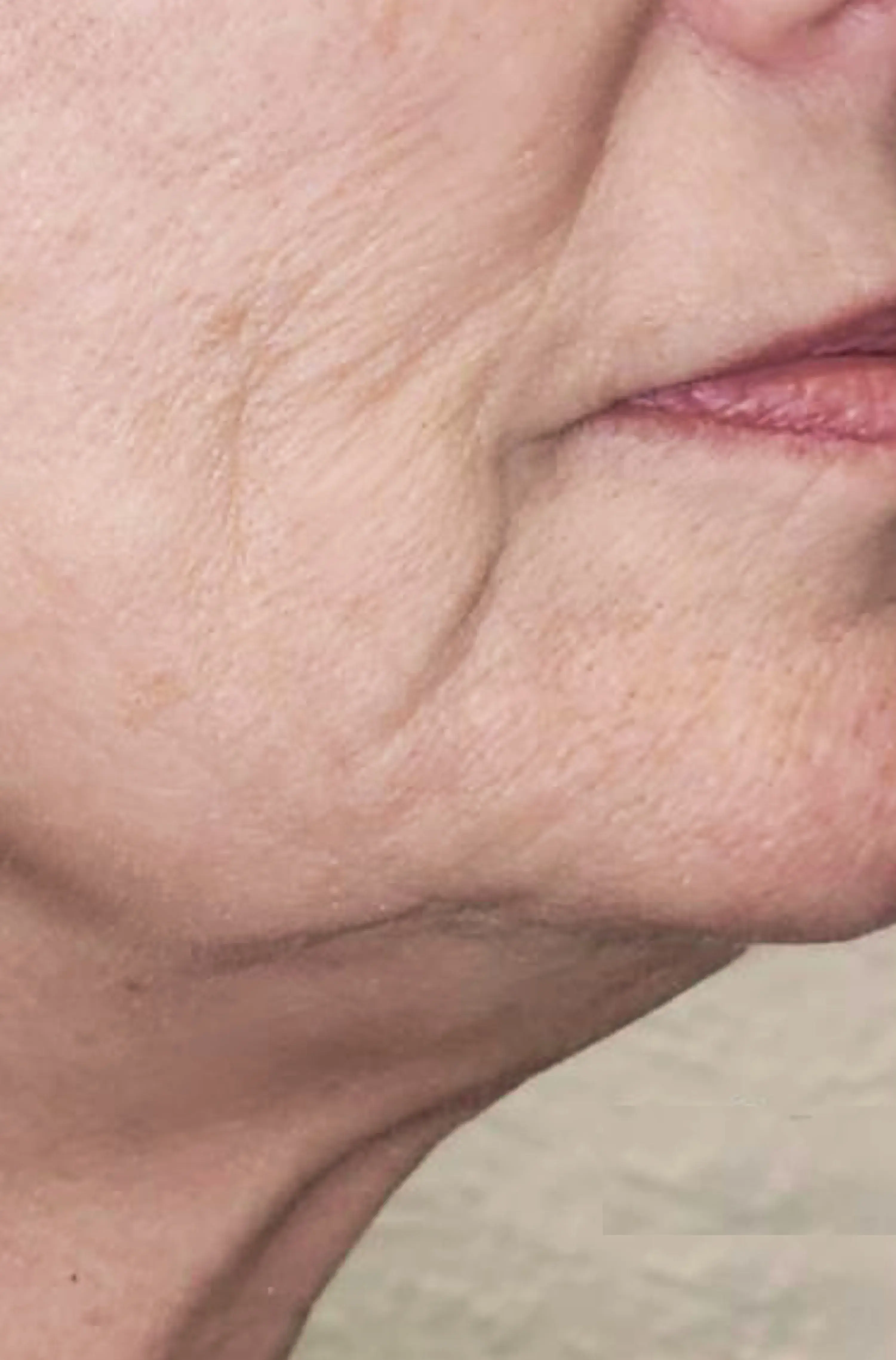 Neck Lift before Denza treatment